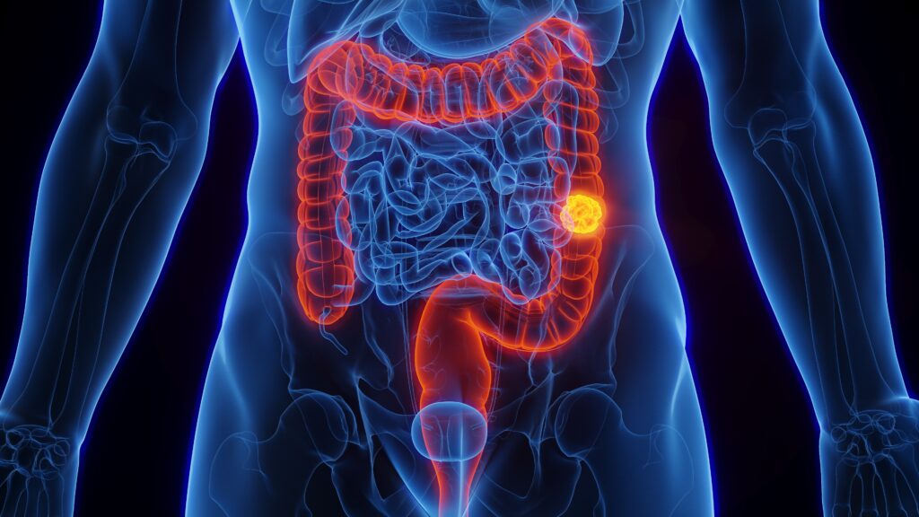 SUS terá novo exame de fezes para detectar câncer de intestino
