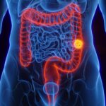 SUS terá novo exame de fezes para detectar câncer de intestino