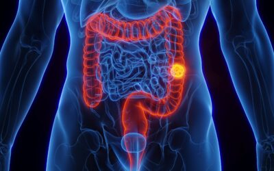SUS terá novo exame de fezes para detectar câncer de intestino