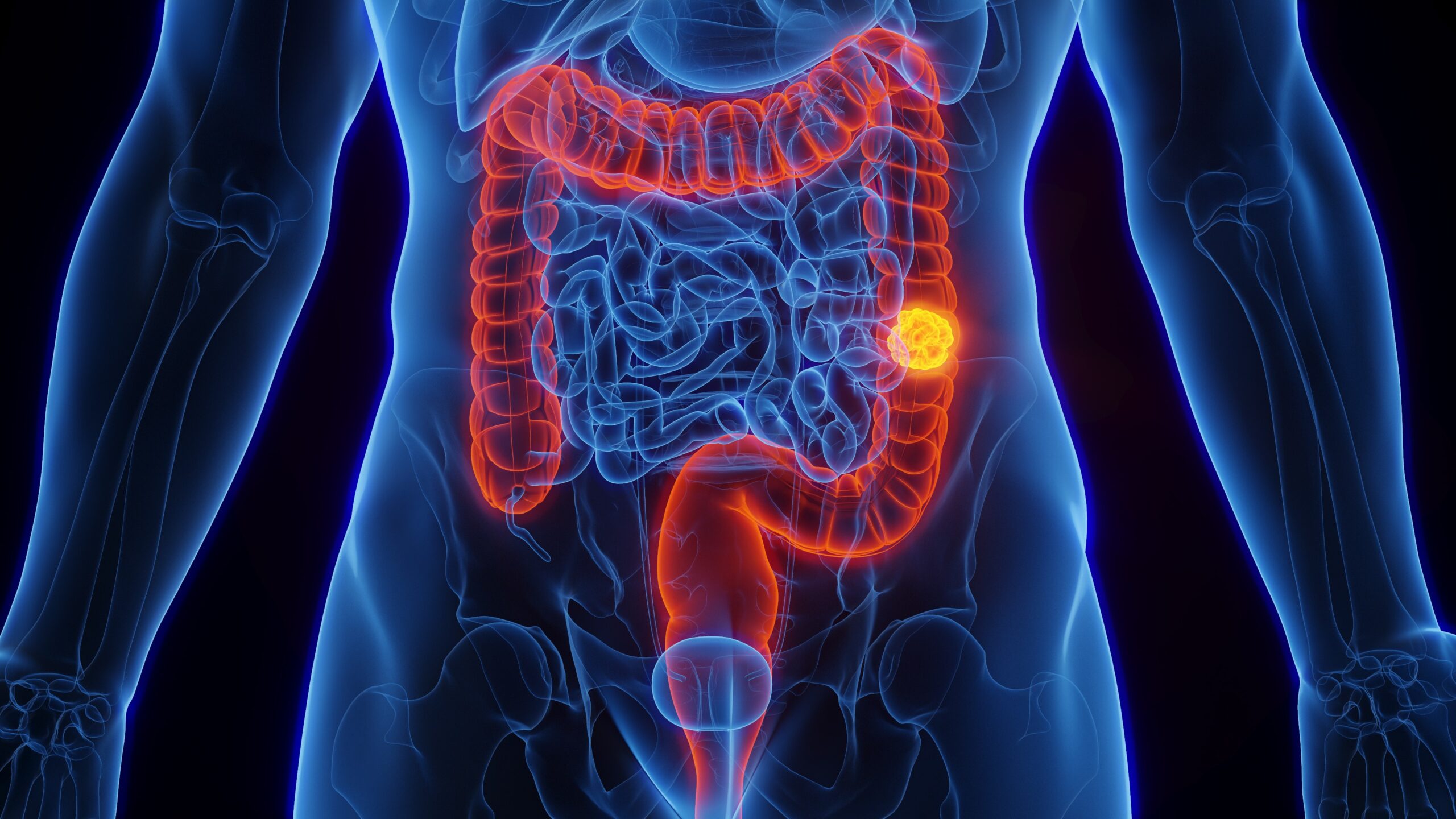 SUS terá novo exame de fezes para detectar câncer de intestino